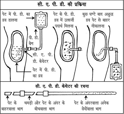Kidney In Hindi