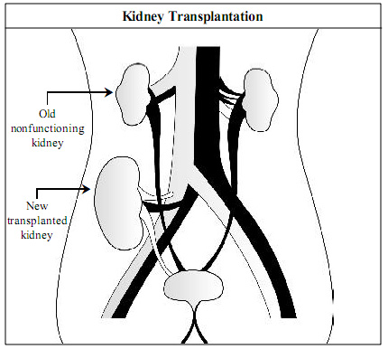 Kidney Transplantation in spanish Language